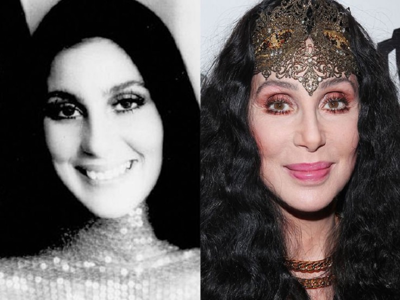 Cher Plastic Surgery